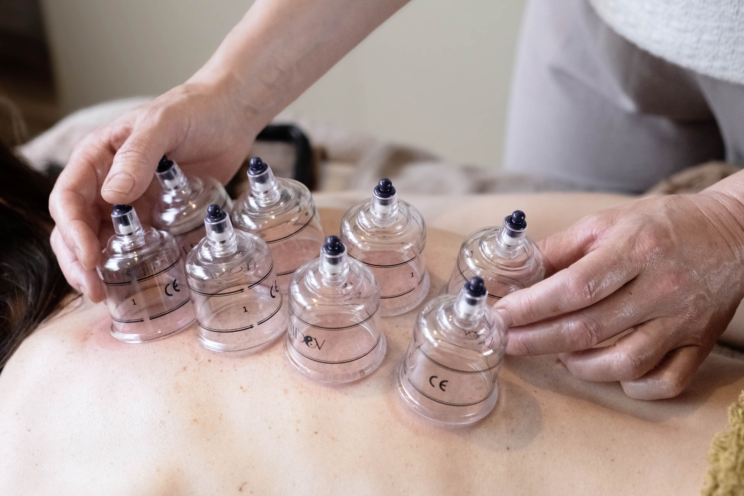 Cupping behandeling